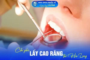 Lấy cao răng ở Hạ Long