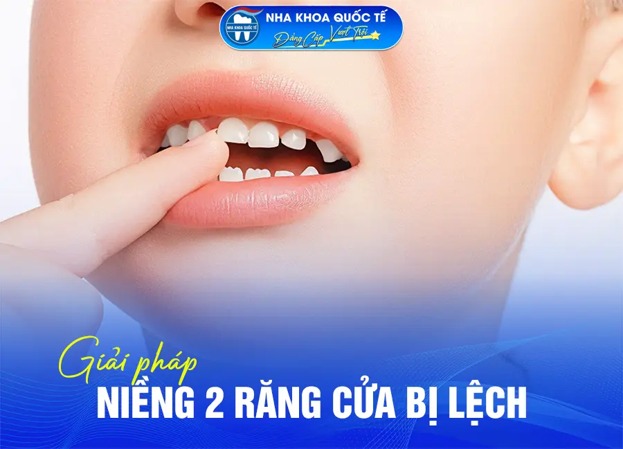 Niềng 2 răng cửa bị lệch