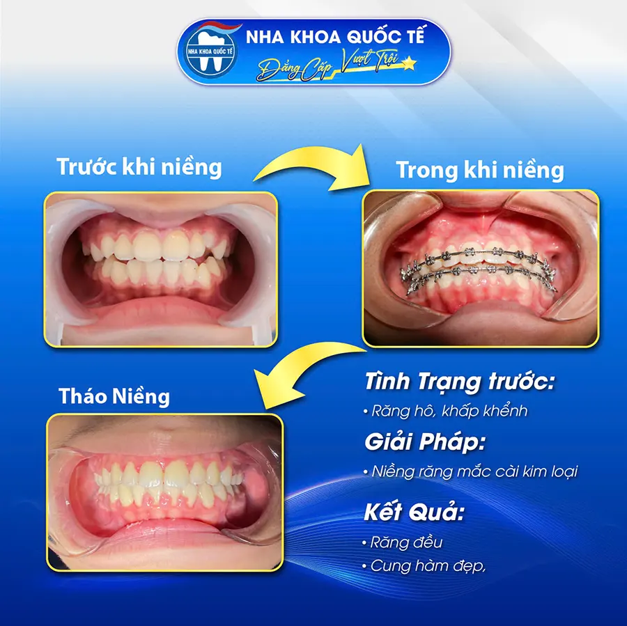 Thành quả sau quá trình niềng răng