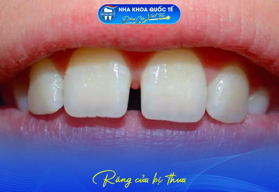Răng cửa bị thưa