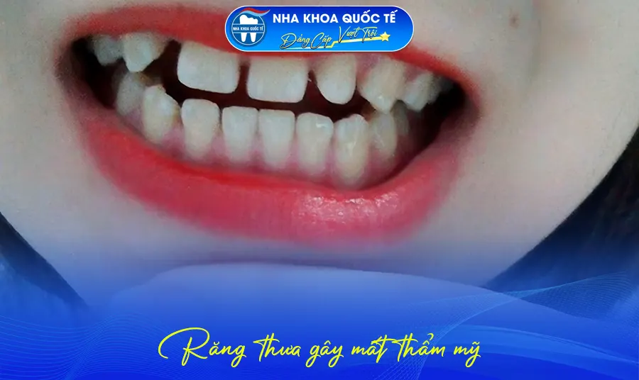 Răng thưa mất thẩm mỹ