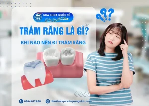 Tìm hiểu về dịch vụ Trám răng