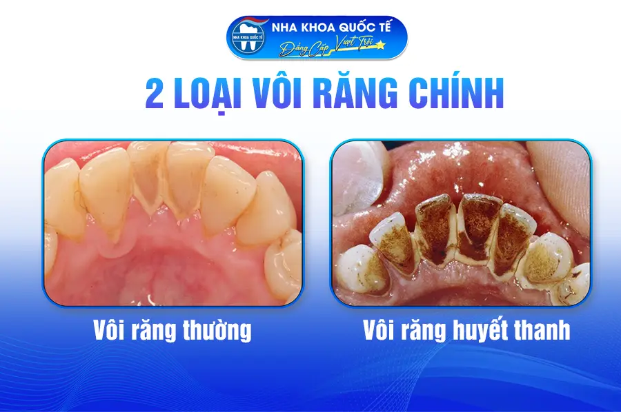 Các loại vôi răng
