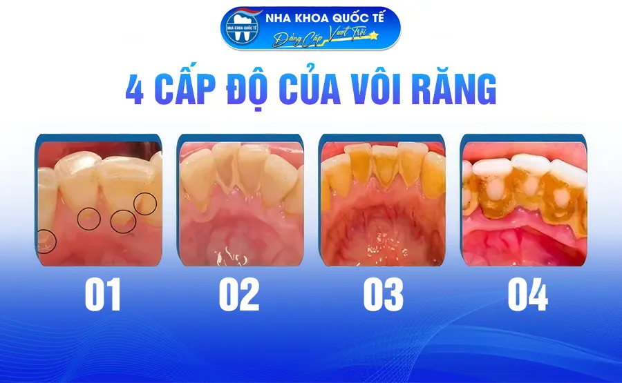 4 cấp độ vôi răng