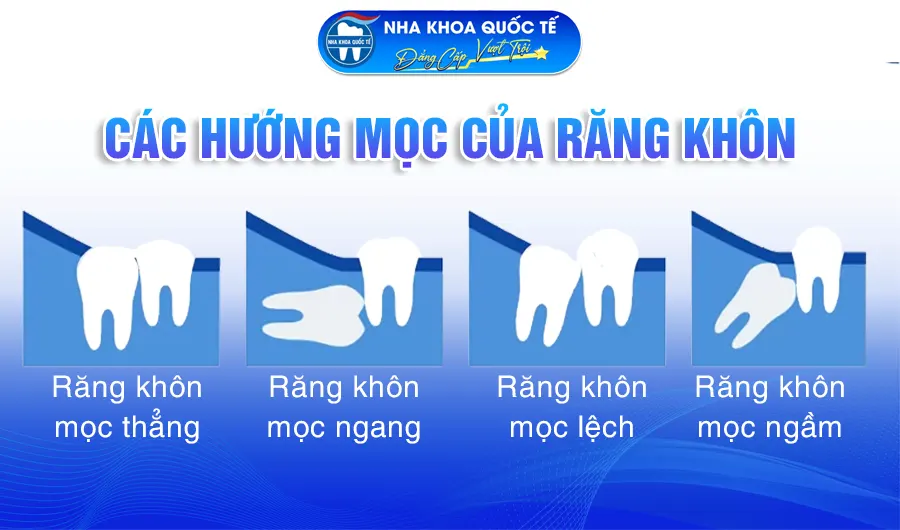 Các hướng mọc răng khôn