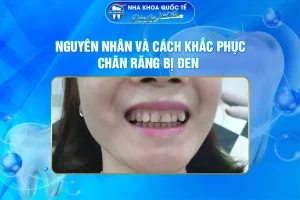 Chân răng bị đen