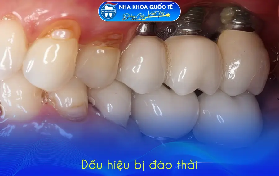 Dấu hiệu implant bị đào thải