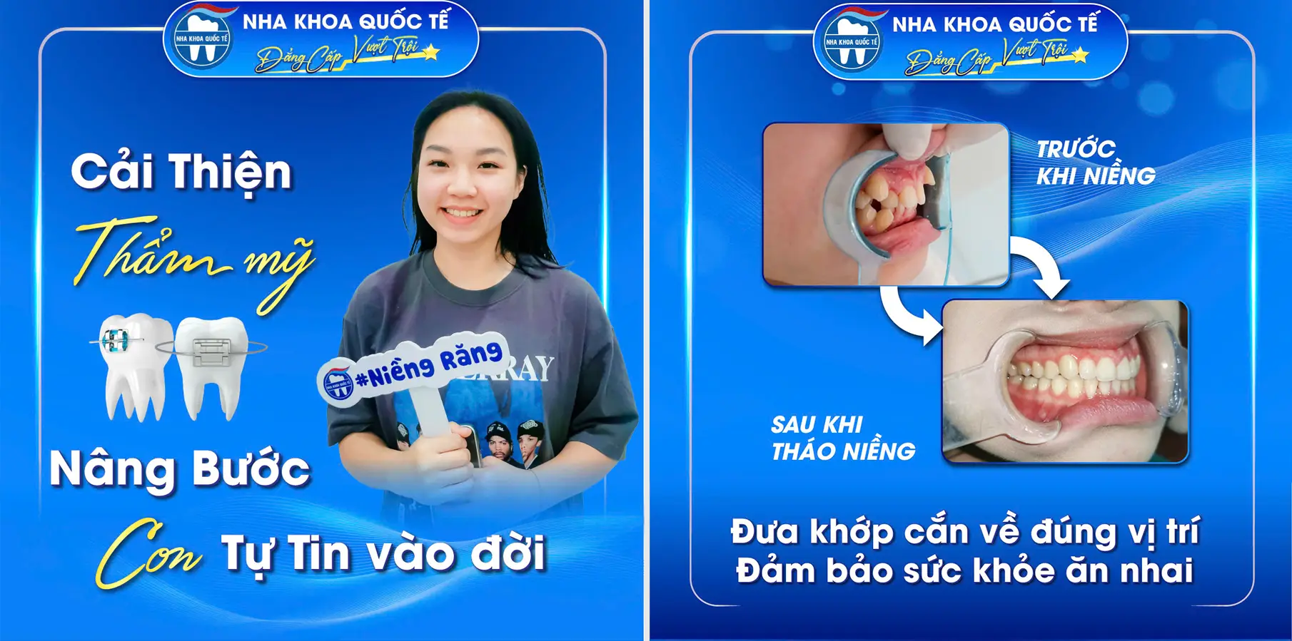 Kết quả sau niềng răng