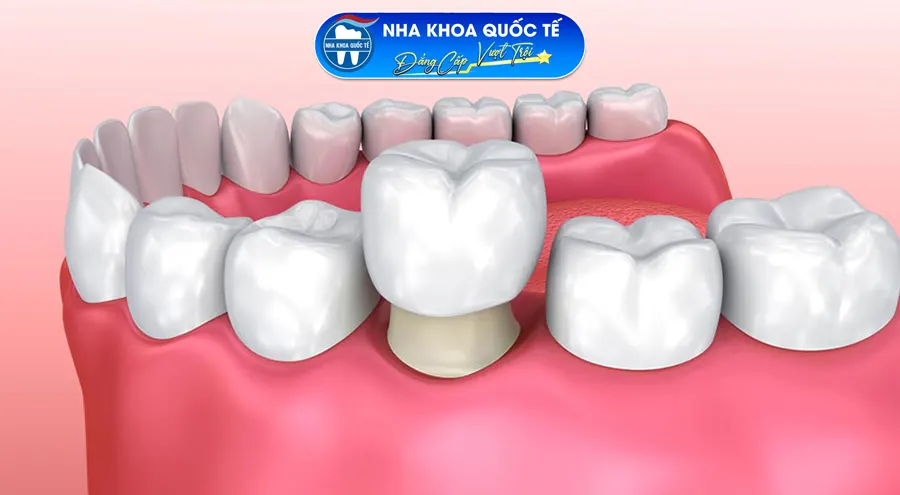 Bọc răng sứ là giải pháp tối ưu