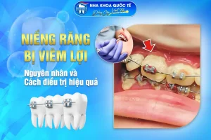 viêm lợi khi niềng răng