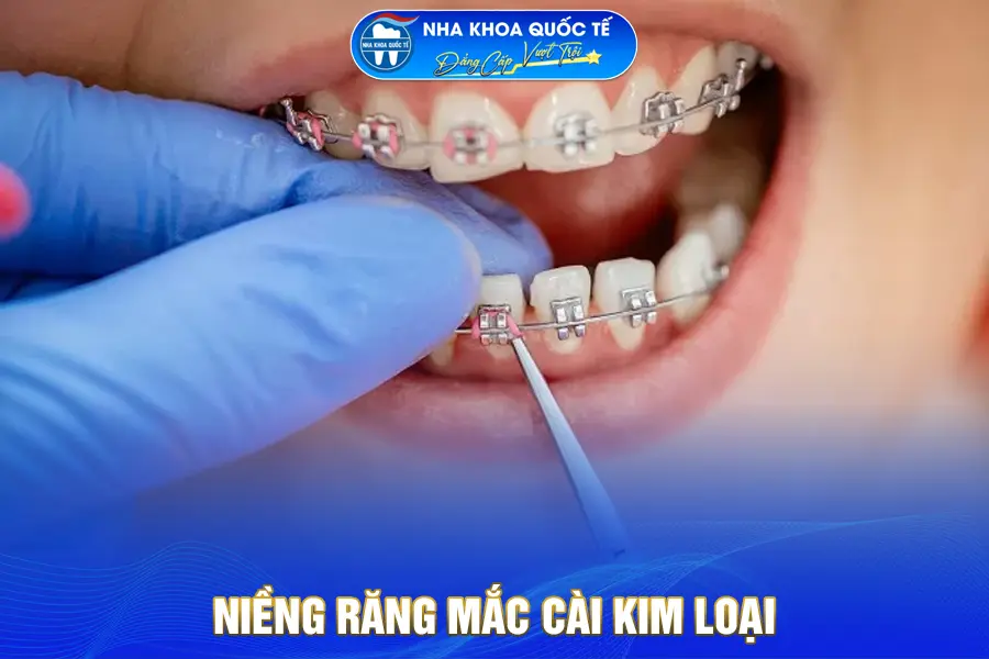Niềng răng mắc cài kim loại