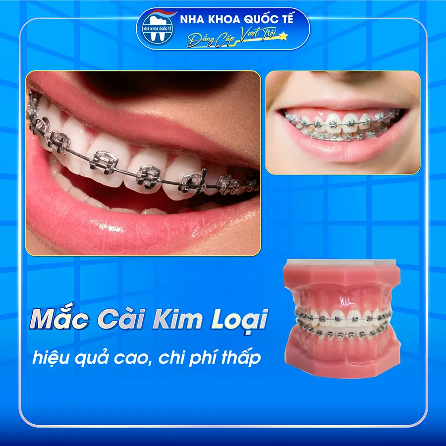 Niềng răng mắc cài kim loại tại Hạ Long