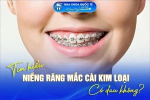 Niềng răng mặc cài kim loại có đau không