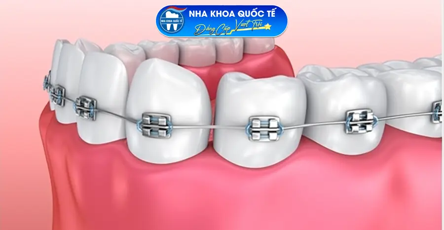 Niềng răng mắc cài