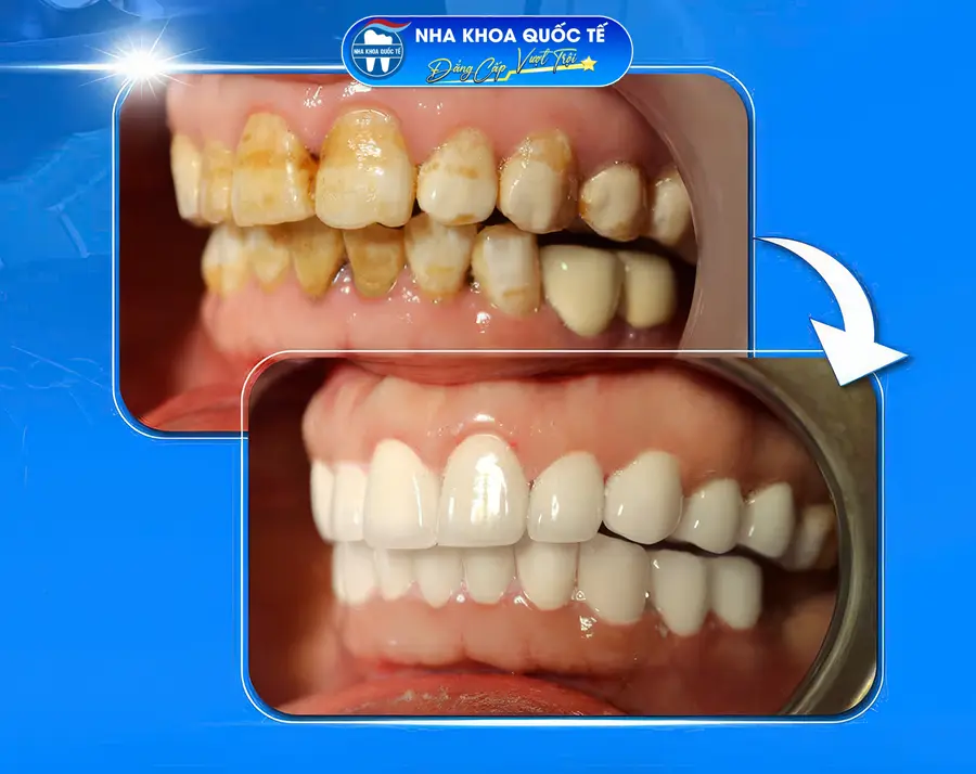 Bọc răng sứ thẩm mỹ