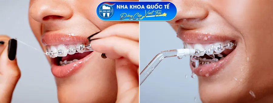 Sử dụng tăm nước và chỉ nha khoa vệ sinh răng niềng