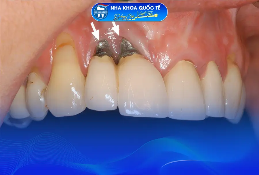 Trụ Implant bị đào thải