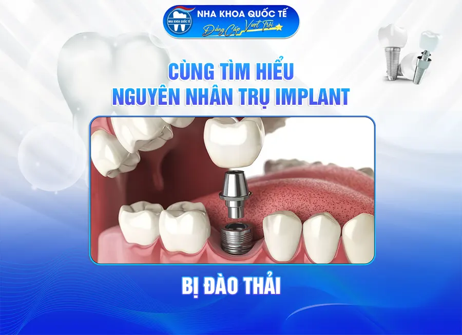 Nguyên nhân Trụ Implant bị đào thải
