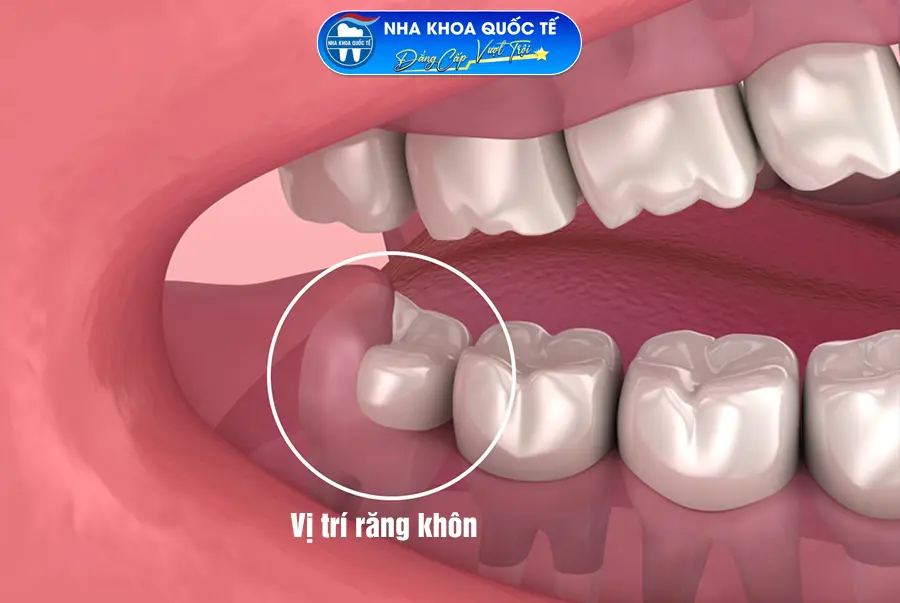 Vị trí răng khôn