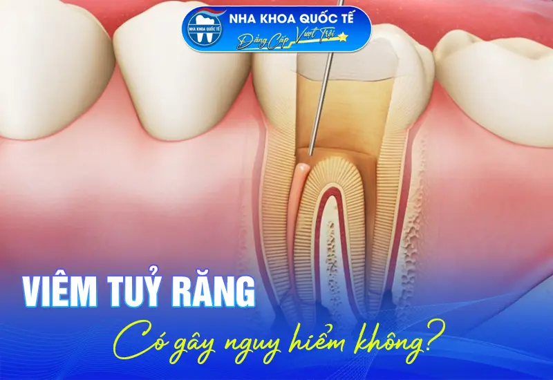 Viêm tuỷ răng