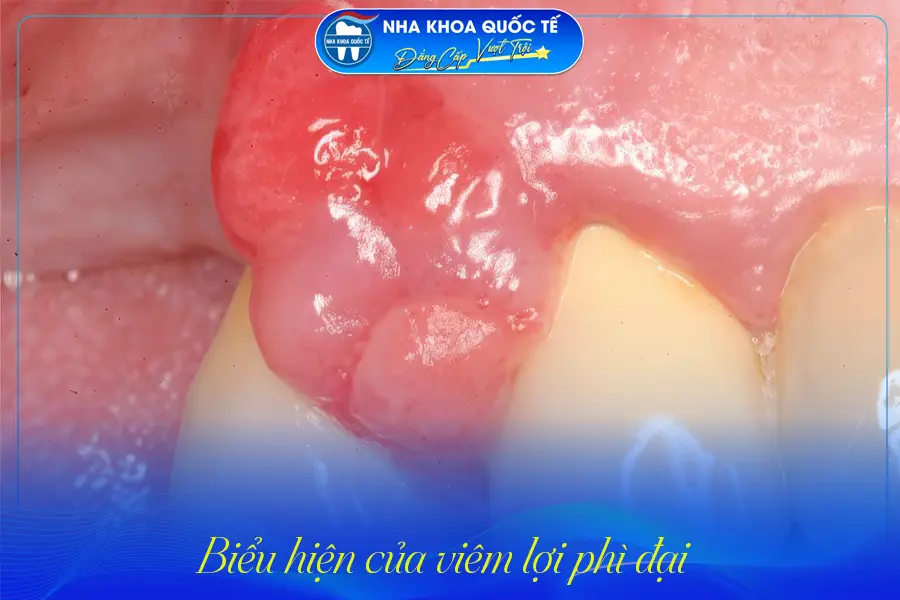 Biểu hiện viêm lợi phì đại