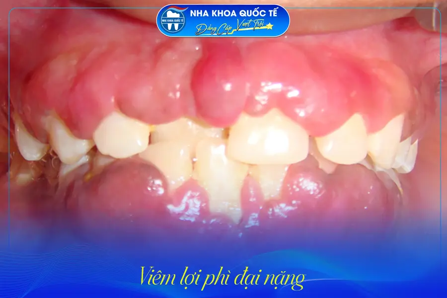Cấp độ nặng của viêm lợi phì đại
