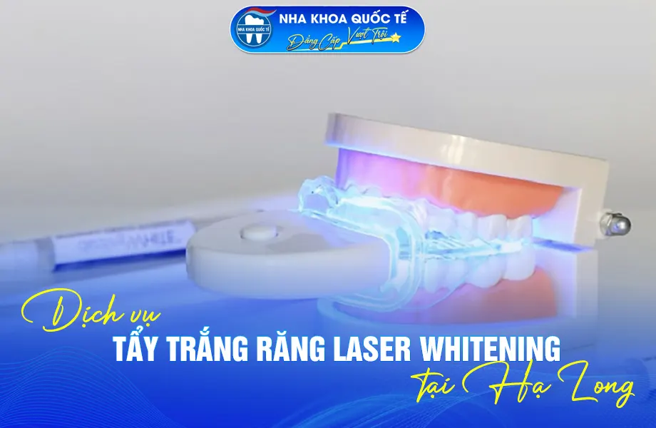 Tẩy trắng răng tại Hạ Long