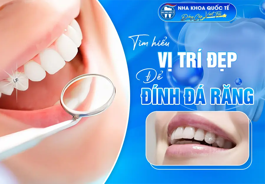 Đính đá vào răng