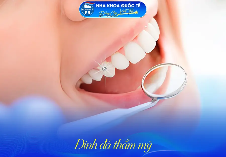 Răng đính đá thẩm mỹ