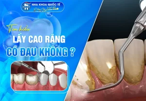 Lấy cao răng có đau không?