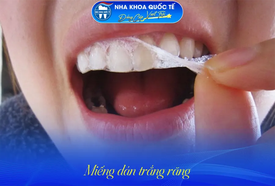 Miếng dán trắng răng