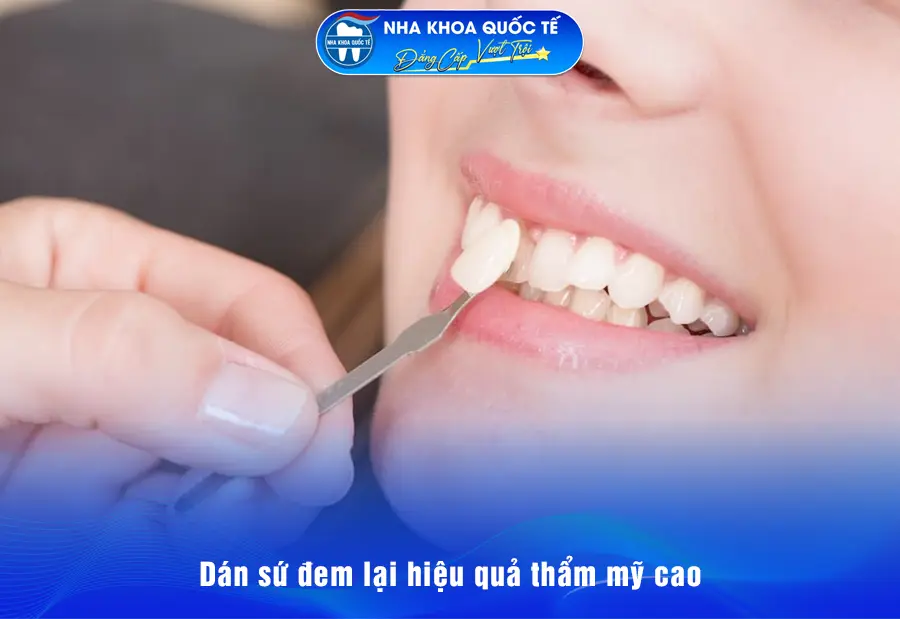 RĂNG SỨ Veneer