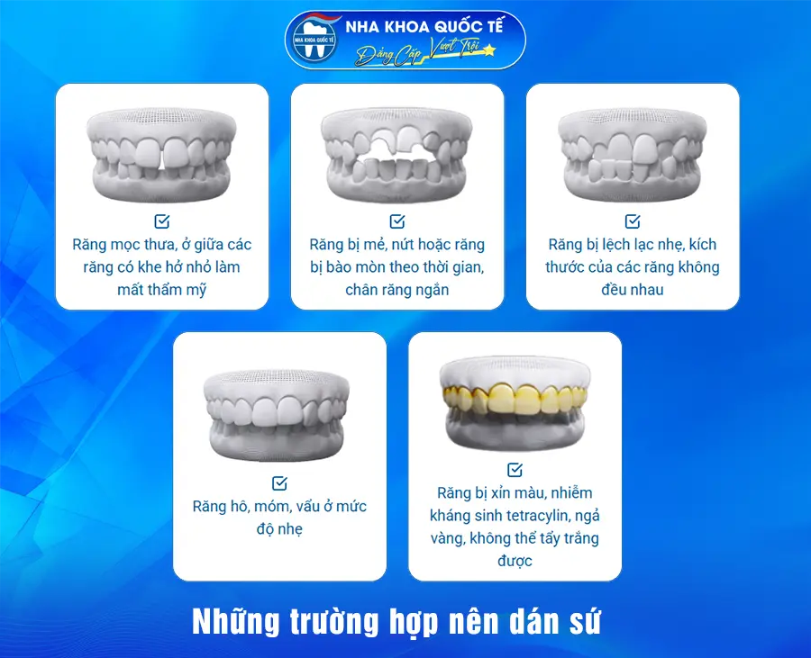Những trường hợp nên dán sứ Veneer