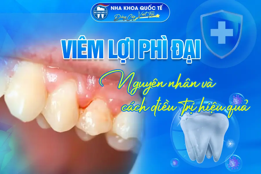 Viêm lợi phì đại