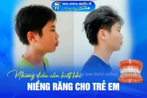 Kiến thức niềng răng trẻ em