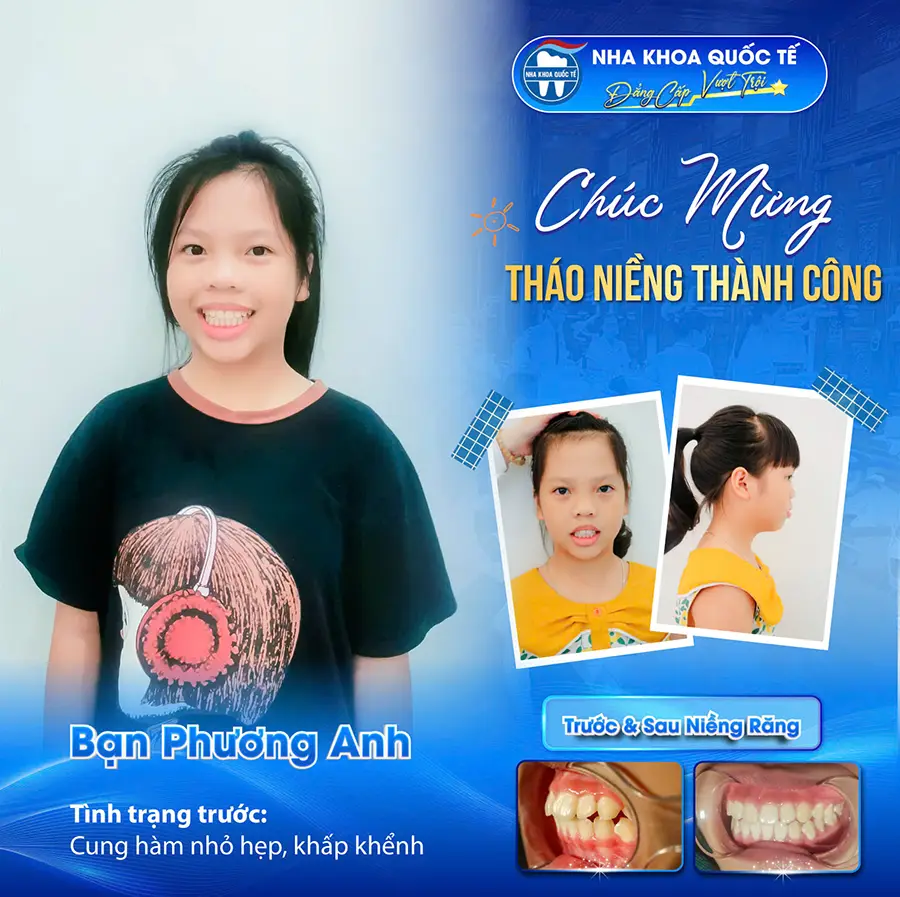 Kết quả niềng răng cho trẻ