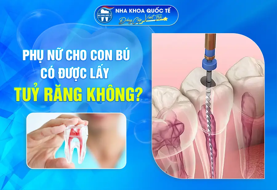 Lấy tuỷ răng cho phụ nữ