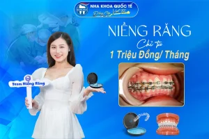 Niềng răng từ 1 triệu