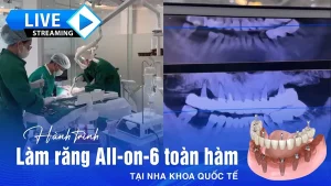 Làm răng All-on-6 toàn hàm