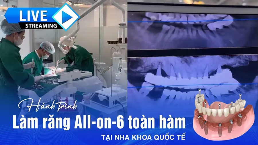 Làm răng All-on-6 toàn hàm