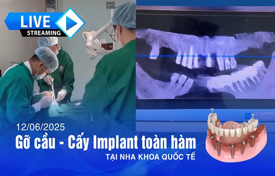 Live cấy ghép implant