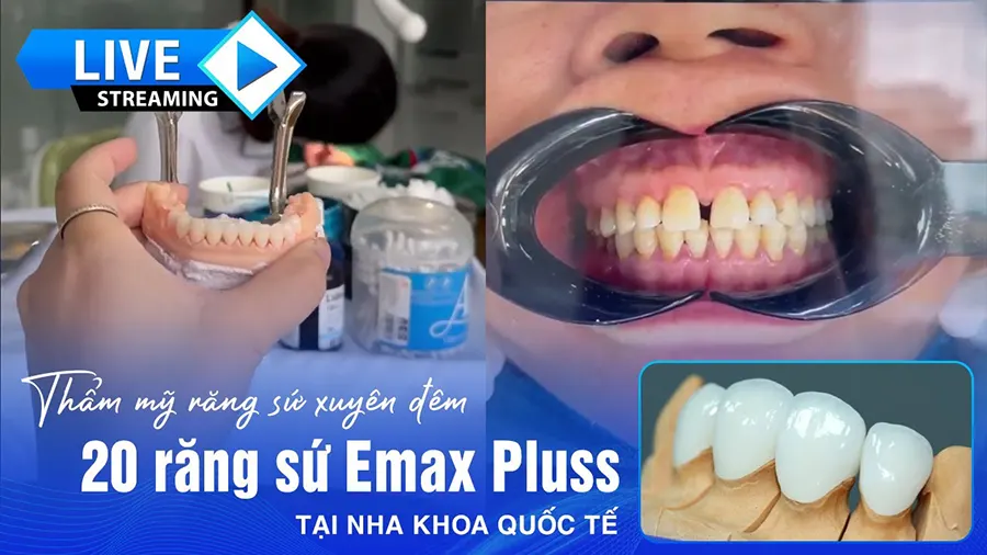 Live gắn 20 răng sứ Emax plus