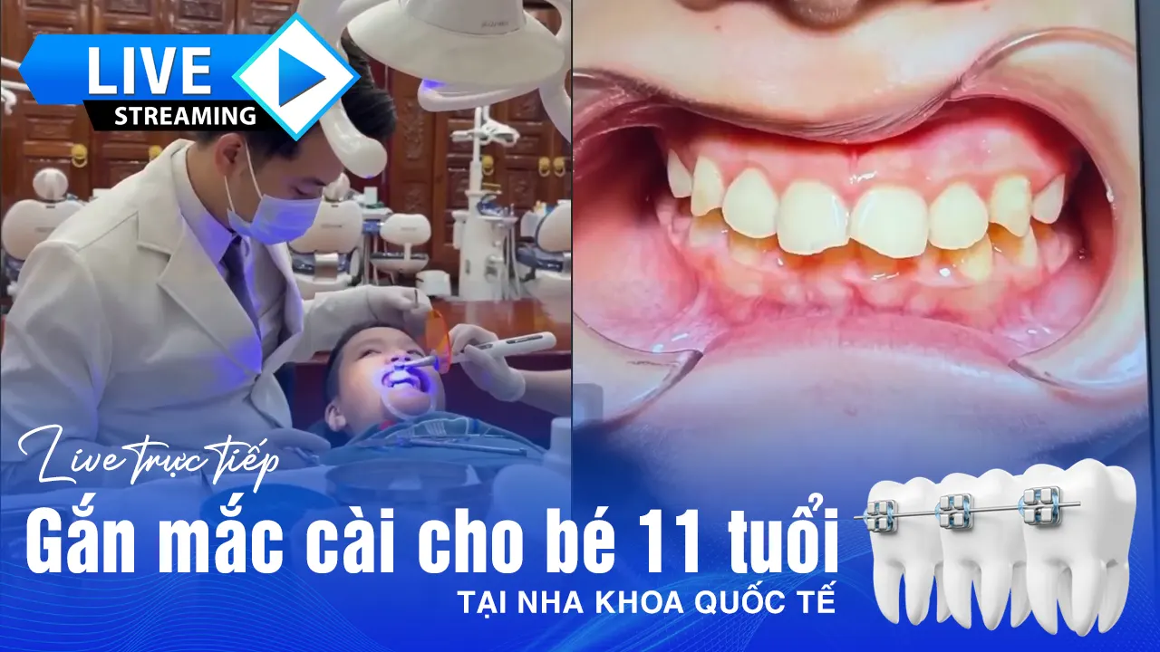 Live gắn mắc cài niềng răng
