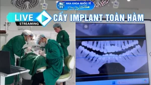 Livetream cấy ghép implant toàn hàm