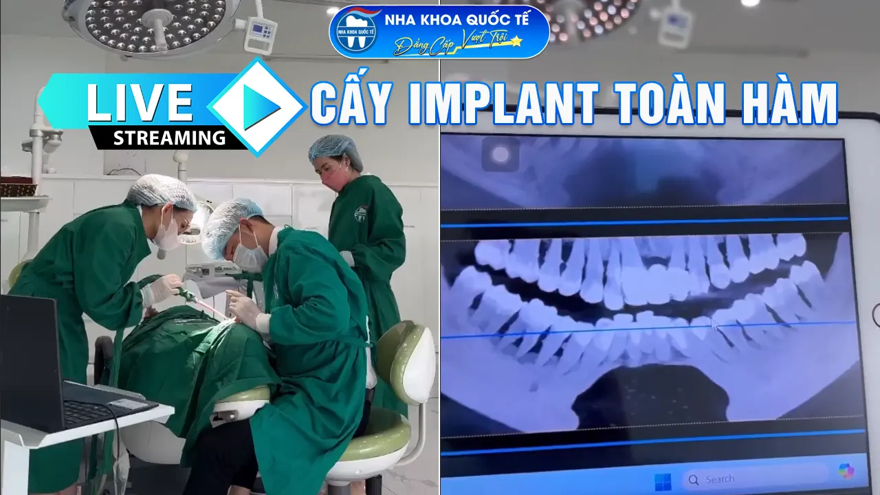 Livetream cấy ghép implant toàn hàm