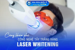 Tẩy trắng răng LASER WHITENING