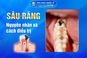 Nguyên nhân và điều trị Sâu răng