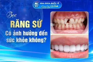 bọc răng sứ có ảnh hưởng sk không