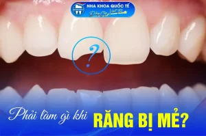 làm gì khi răng bị mẻ