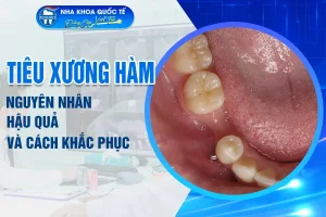 nguyên nhân tiêu xương hàm